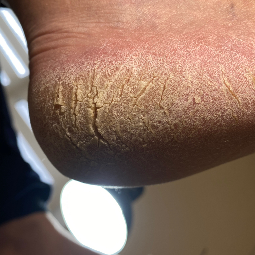 Обработка трещин