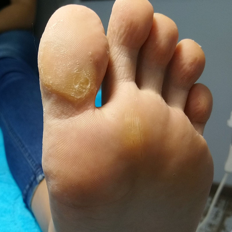 Медицинский педикюр (с минимальными повреждениями)