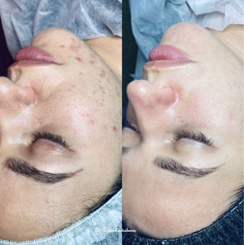 Лечение акне / acne treatment