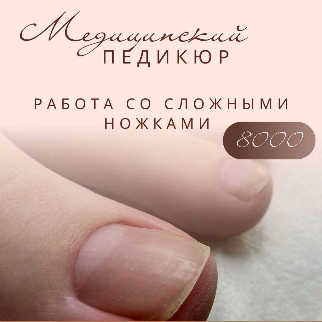 удаление вросшего ногтя ( 2 стороны)