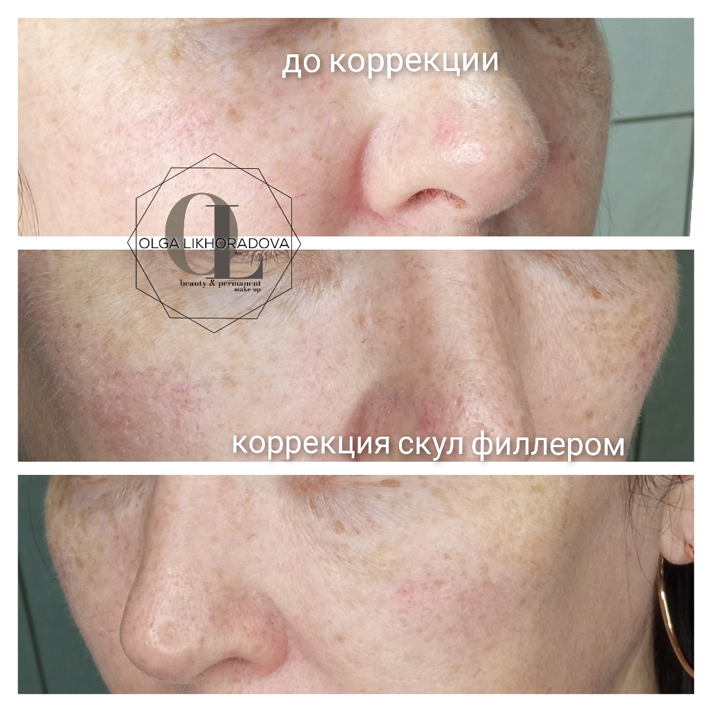 Коррекция скул волюметриком 1 мл