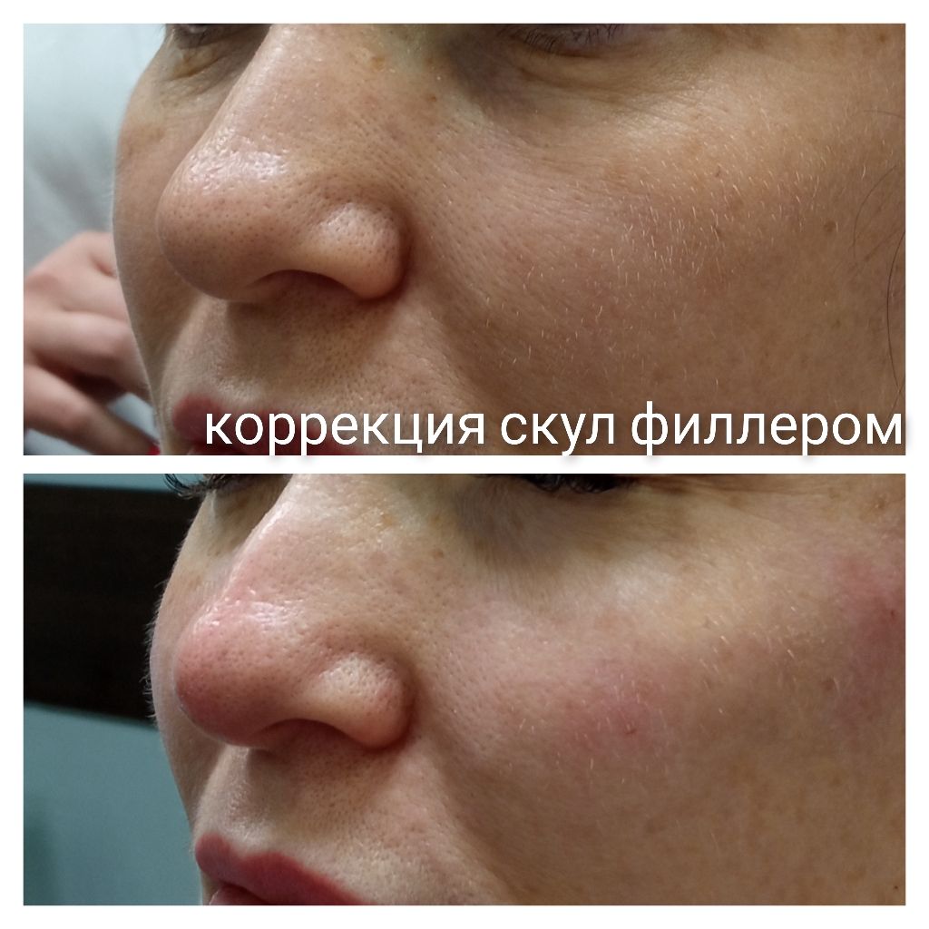 Контурная пластика (скулы) 2 мл