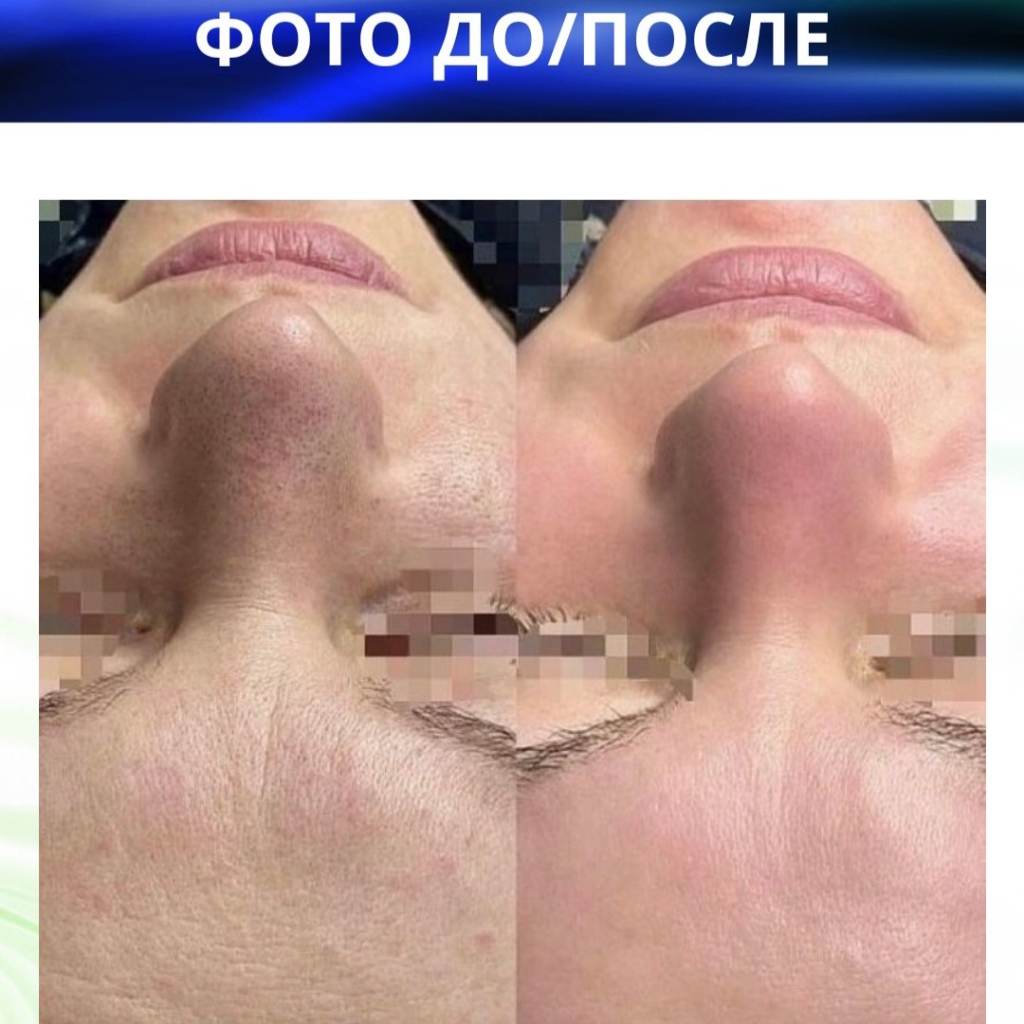 Пилинг BioRePeel
