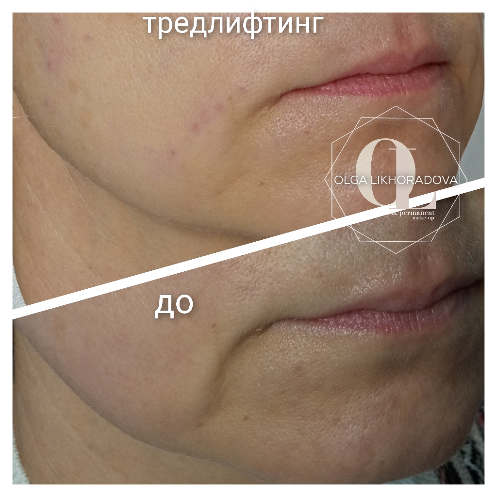 Подтяжка кожи 3D – мезонитями (тредлифтинг) - моно – мезонити, 10 штук