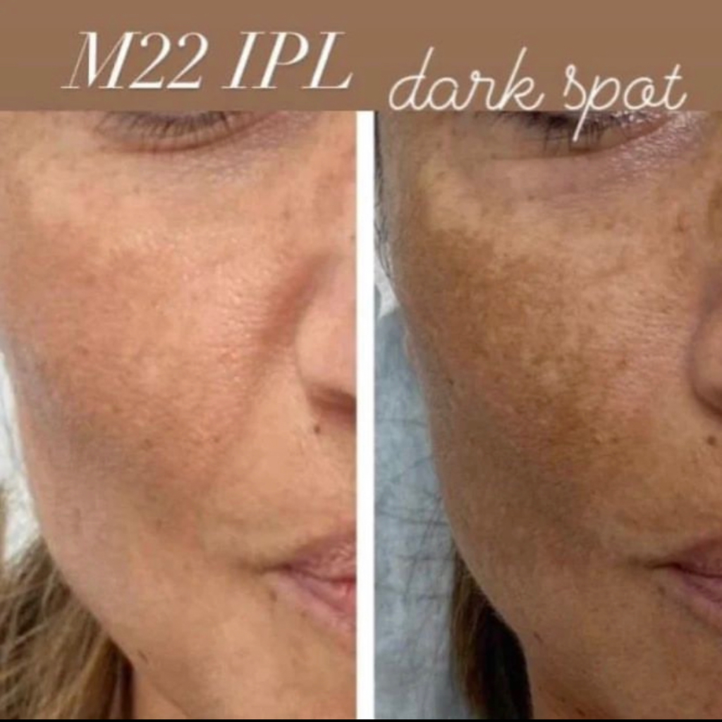 DARK SPOTS (M22 laser IPL)