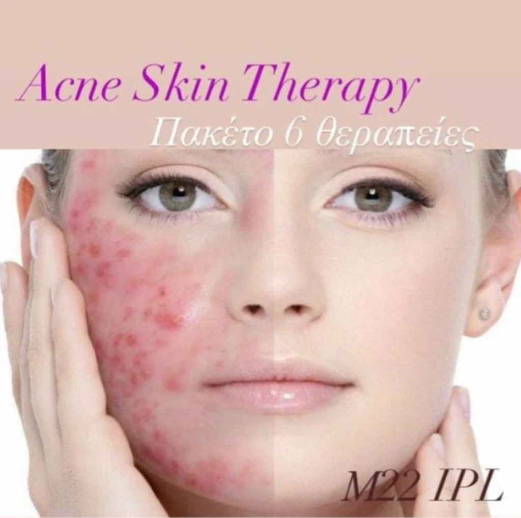 ACNE THERAPY M22 IPL LASER