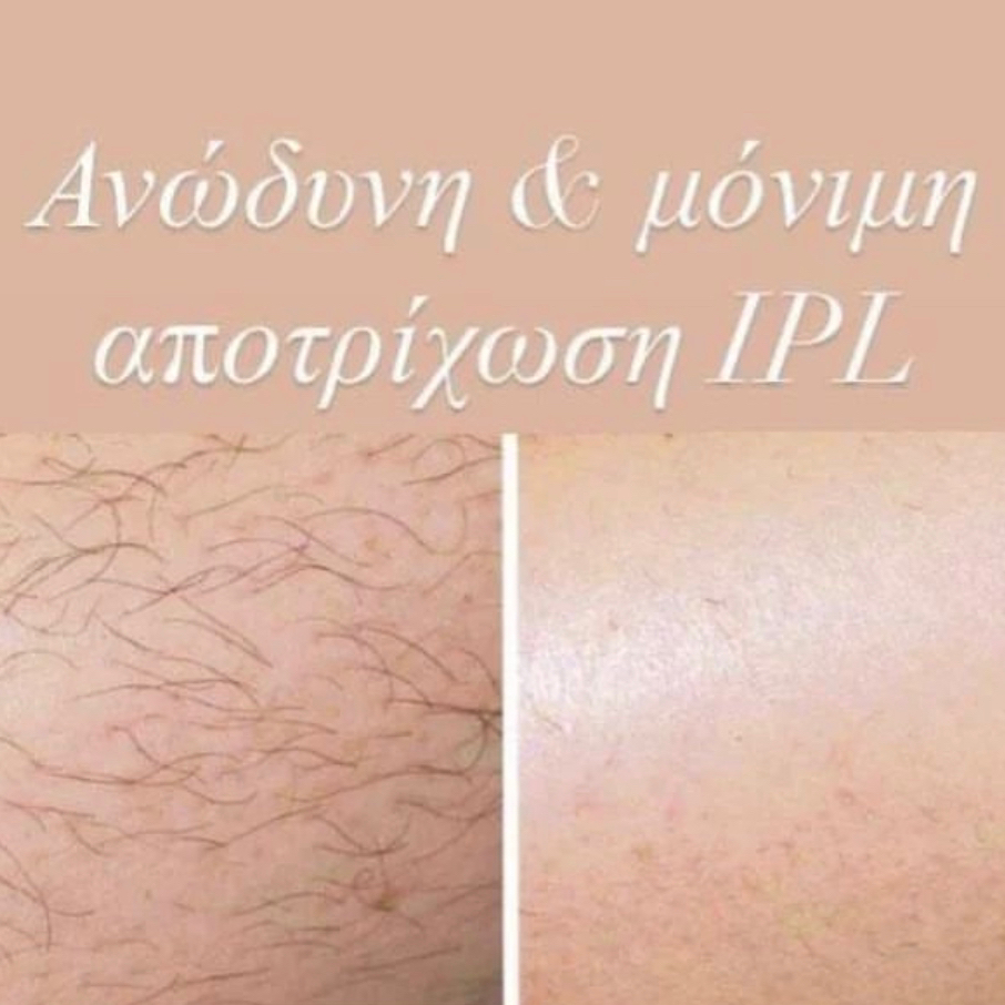 ΑΠΟΤΡΙΧΩΣΗ 1 ΖΩΝΗ