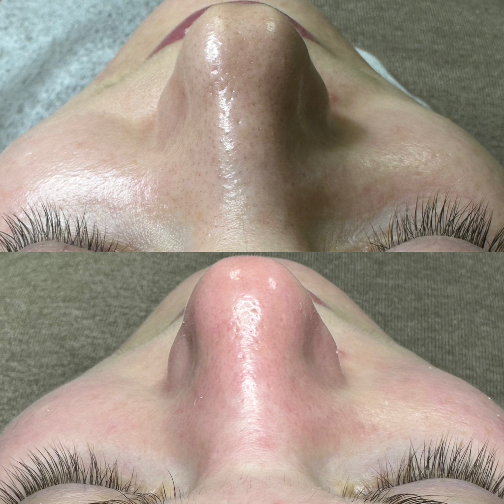 Комбинированная глубокая чистка лица