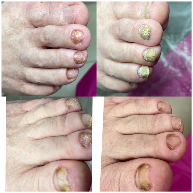 Первичный прием по зачистке тотально пораженных грибком ногтей( без стопы)