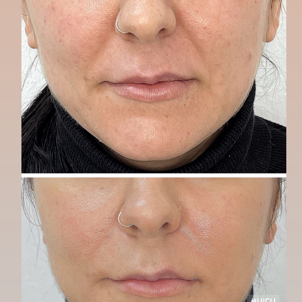 HYALURONIC ACID 1 ml