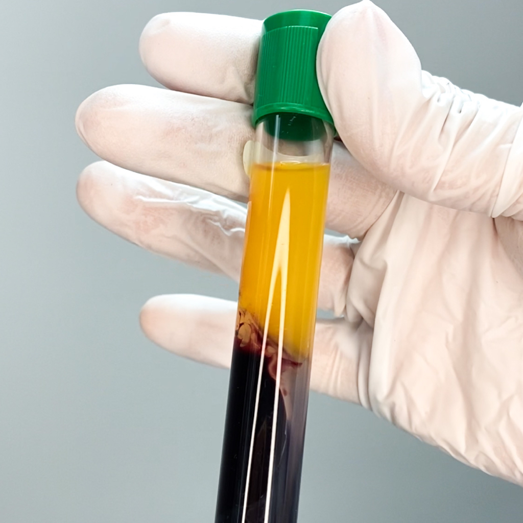 Плазмолифтинг | Плазма PRP