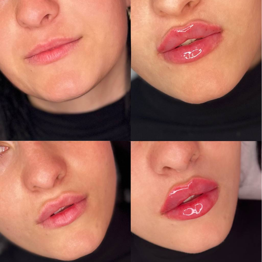 Удаление филлера