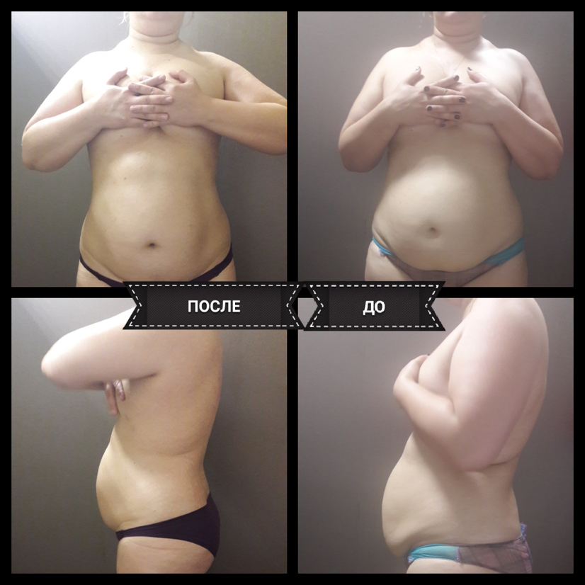 Антицеллюлитный массаж  Зона: бока+живот, с вибро-дренажем