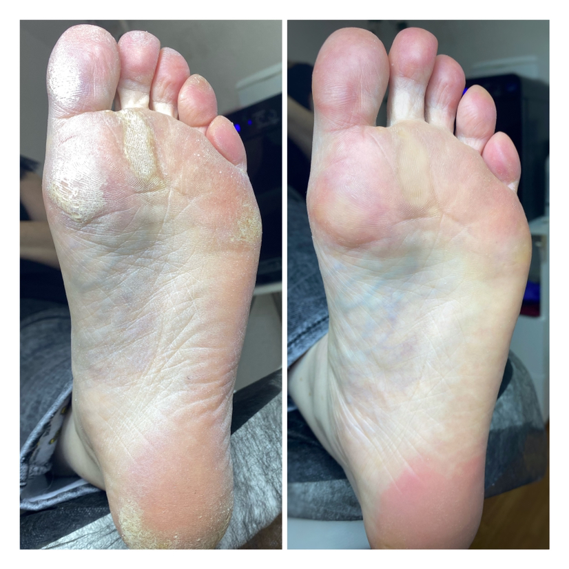 Обработка стопы