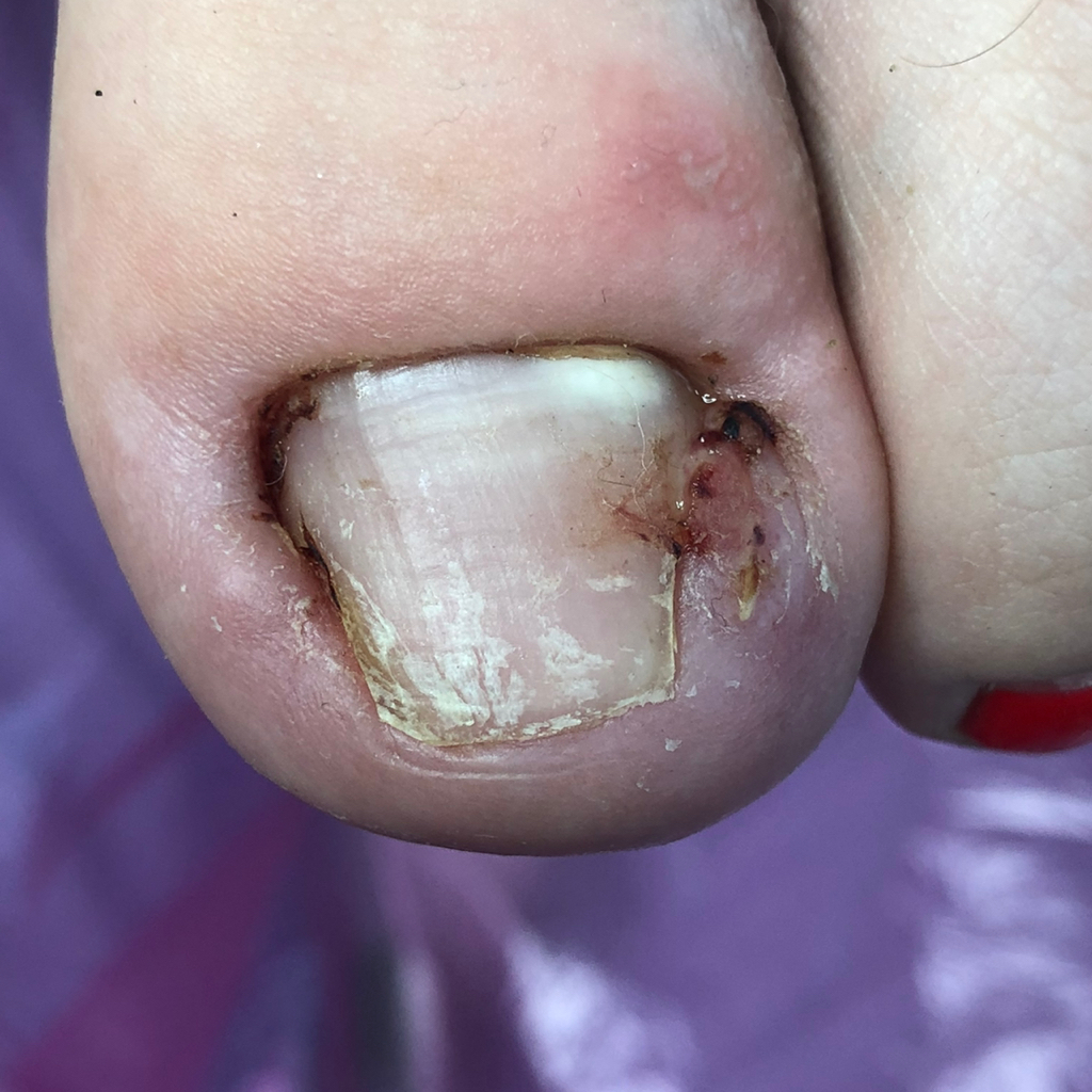 Вросший ноготь
