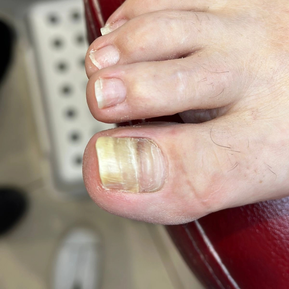 Зачистка онихолизиса