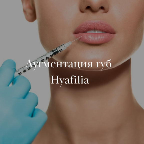 Аугментация губ Repart (Россия)