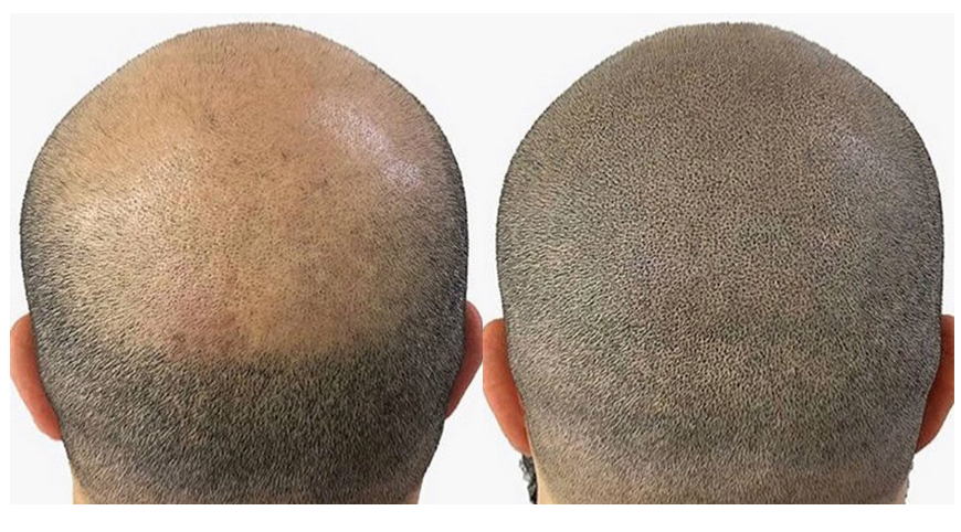 Scalp Micropigmentation 2 hours