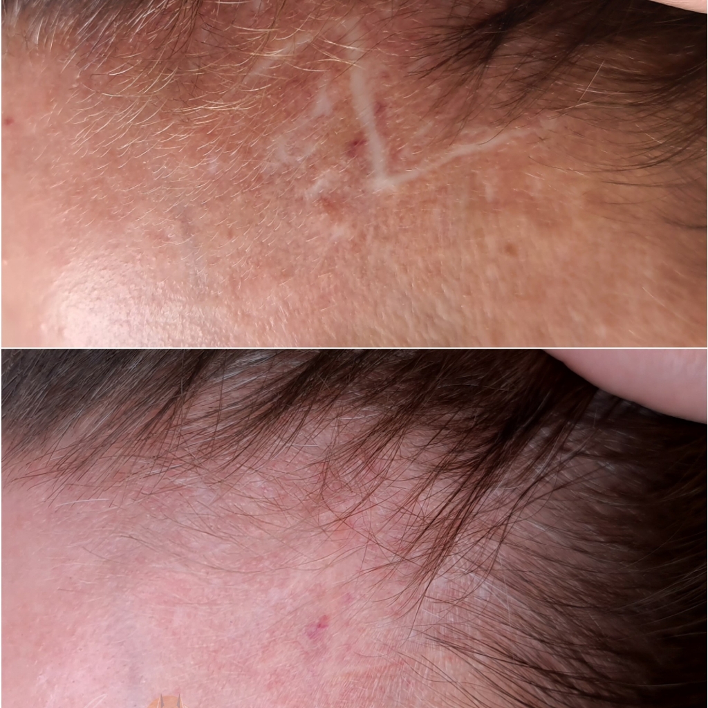 Камуфляж рубцов, пигментных пятен и др.