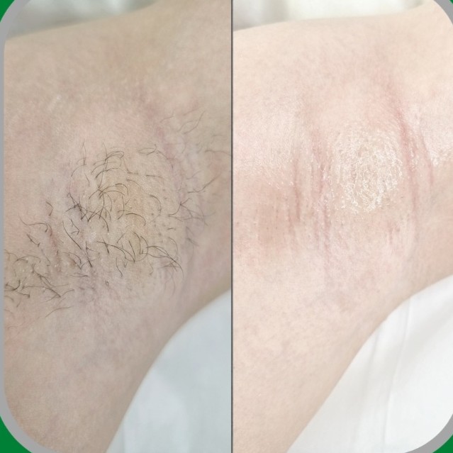 Подмышечные впадины