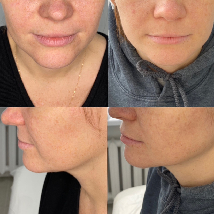 Глубокое увлажнение кожи