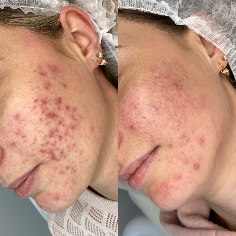 Пилинговая программа MediDerma