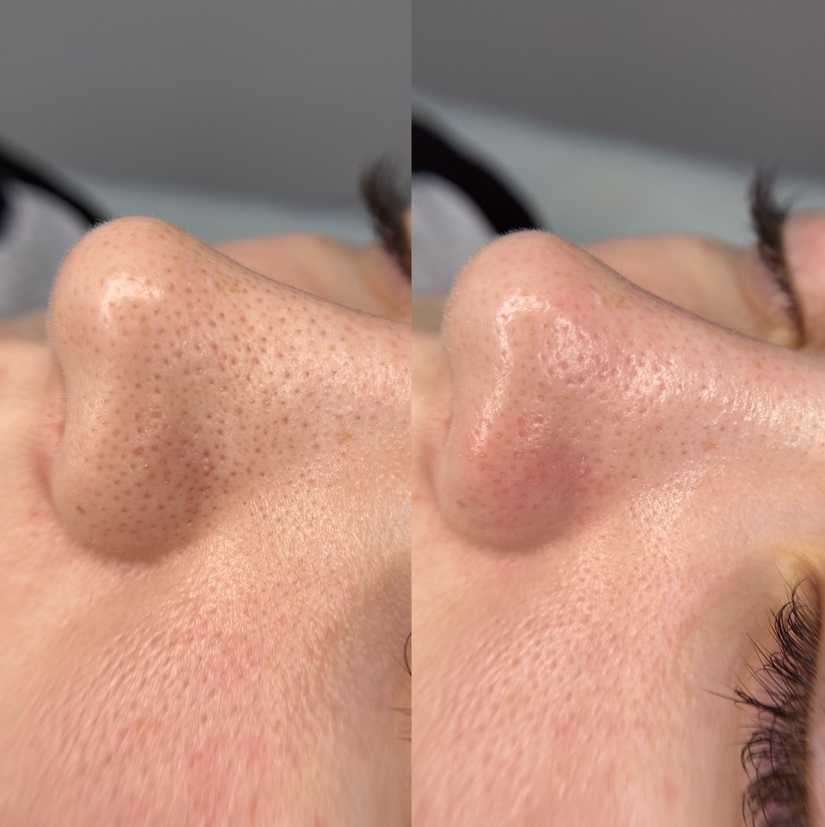 Комбинированная чистка лица + пилинг