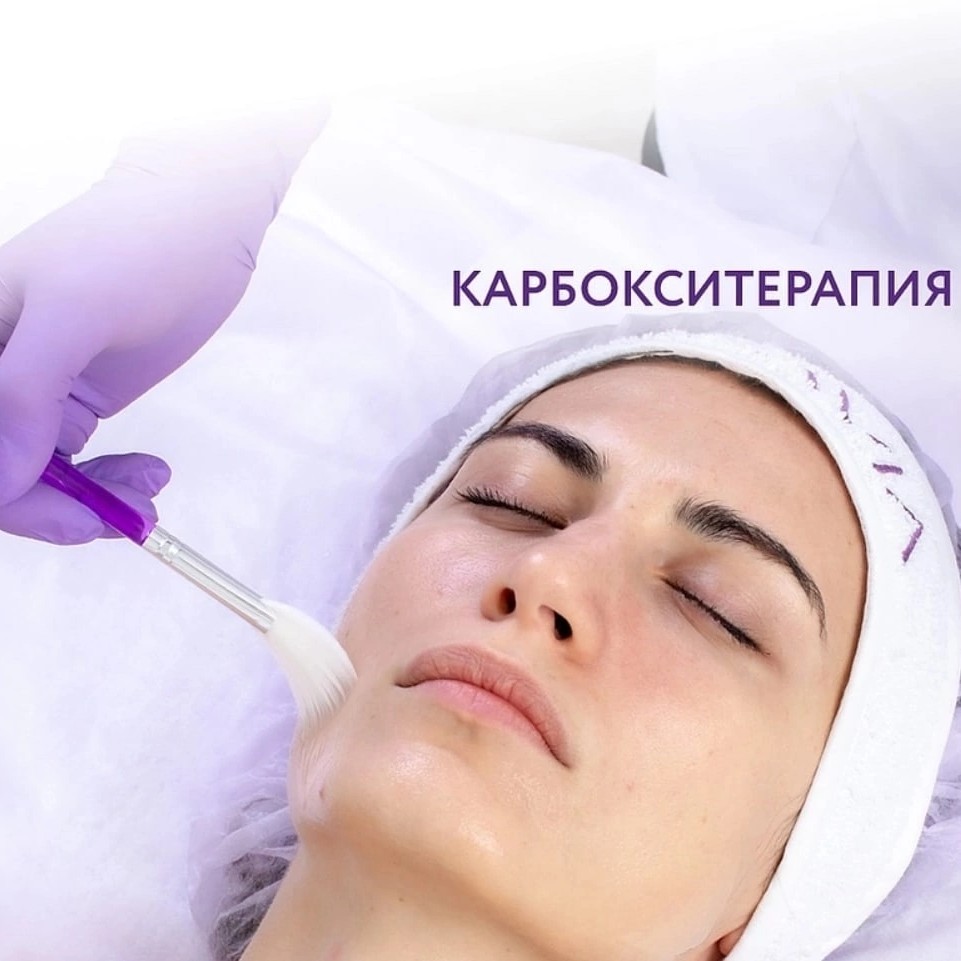 Карбокситерапия