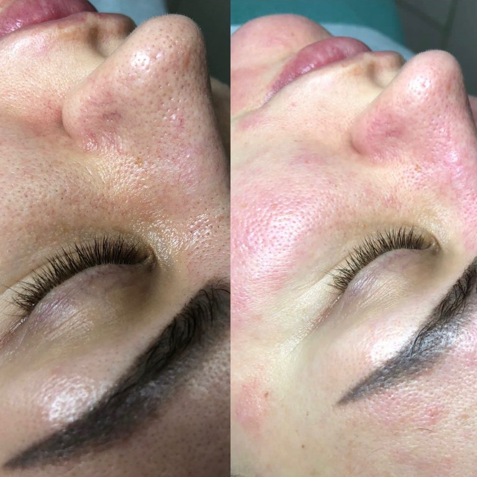 Комбинированная чистка лица