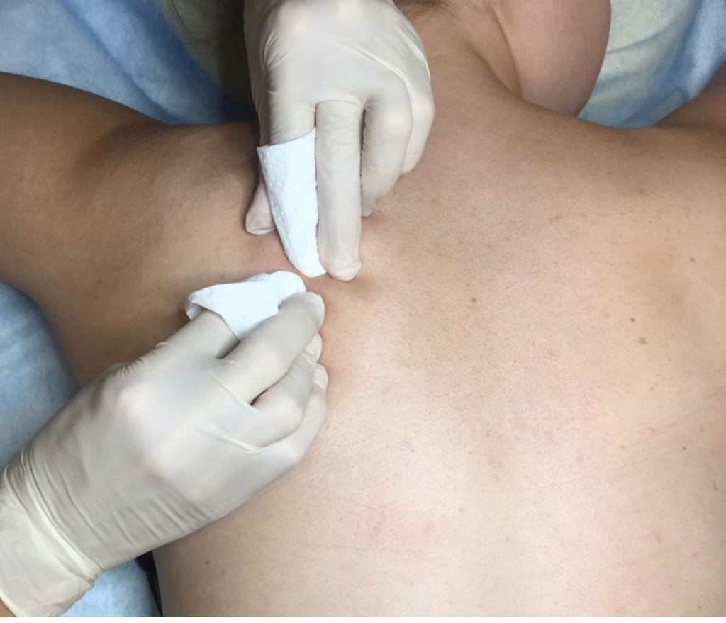 Чистка спины