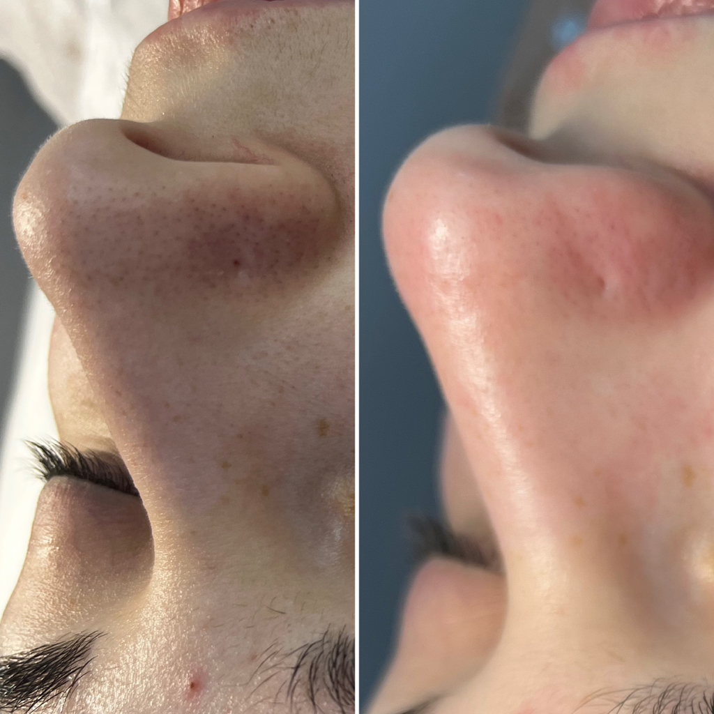 Комбинированная чистка лица+пилинг