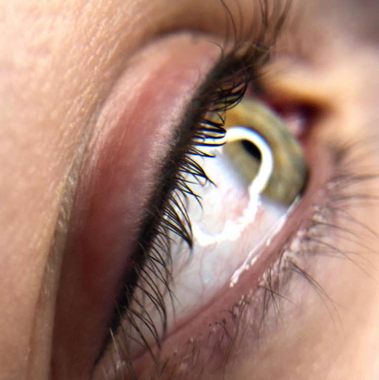 ПМ межресничка