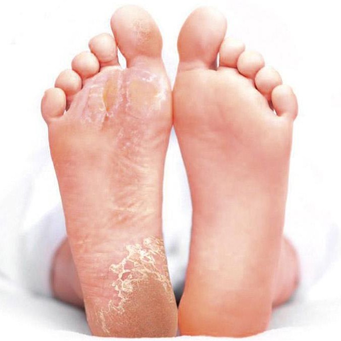 Удаление натоптышей и мозолей