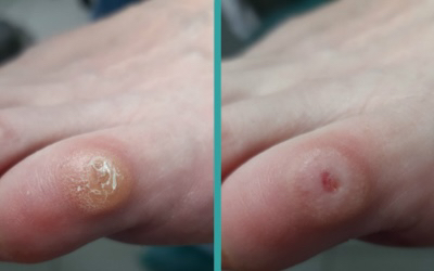 Обработка стержневой мозоли/бородавки 1 ед. (с применением разгрузки,перевязки при необходимости)