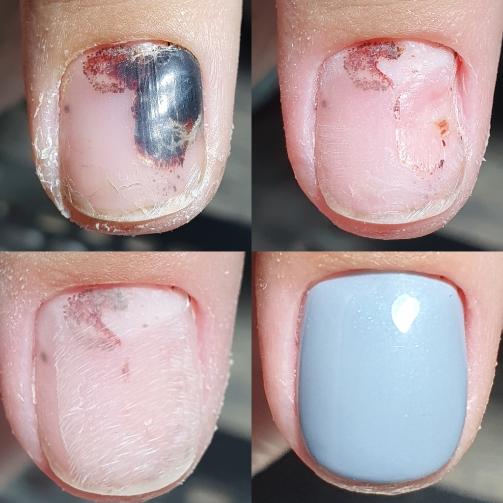 Реконструкция ногтевой пластины + зачистка онихолизиса или травмы