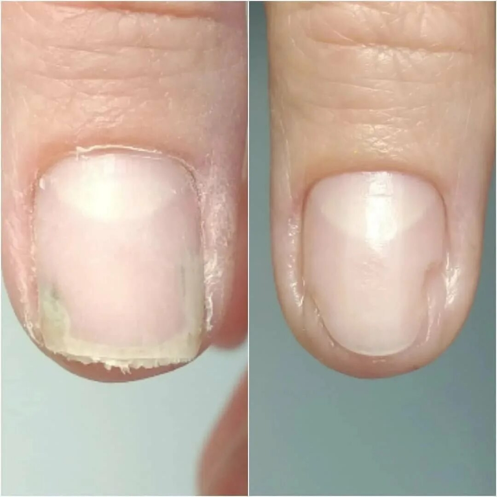 Зачистка онихолизиса (на одном ногте)