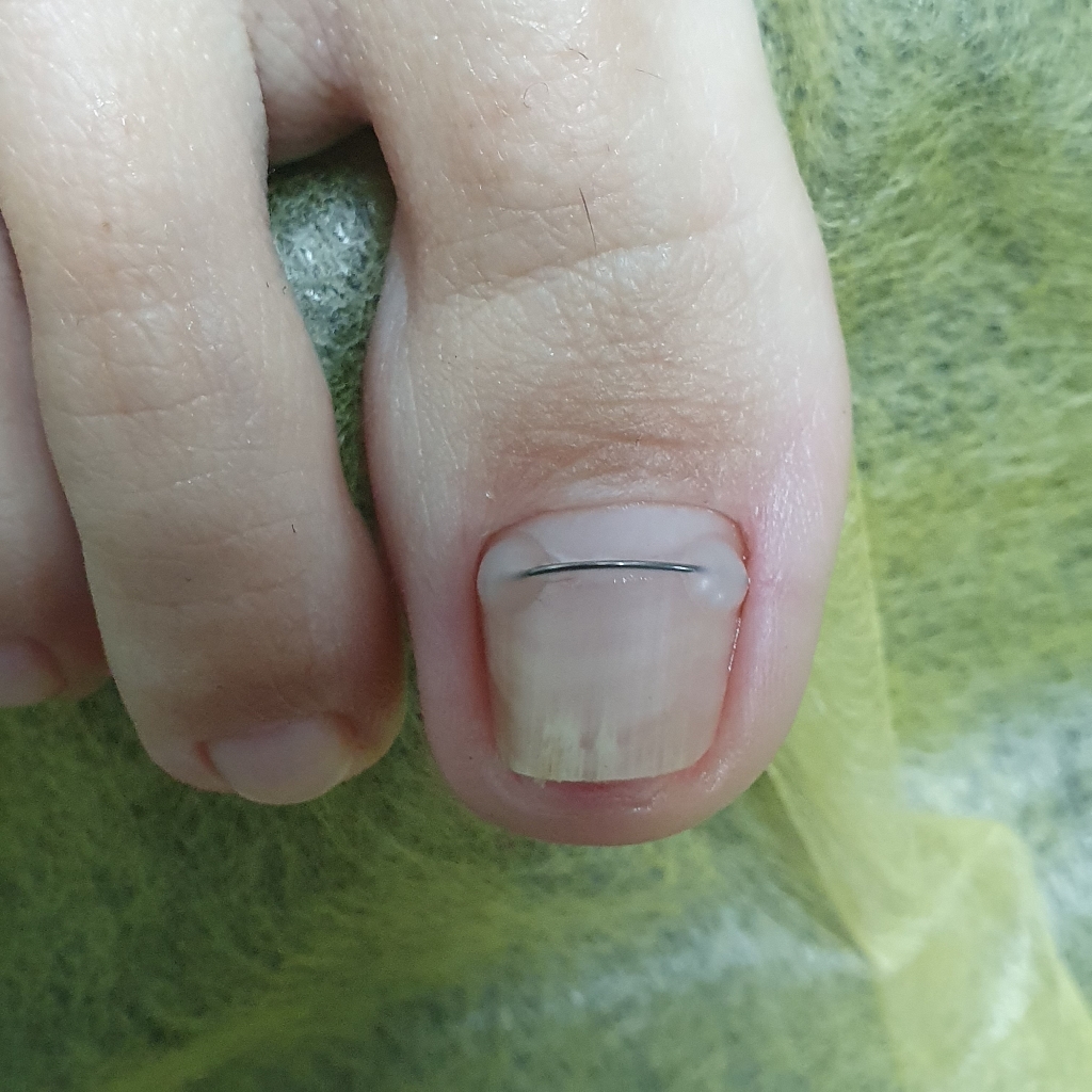 Установка корректирующей системы (на один ноготь)