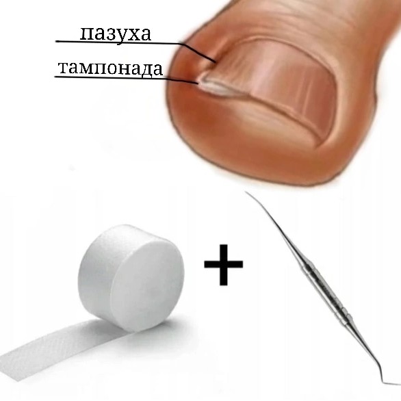 Тампонрование