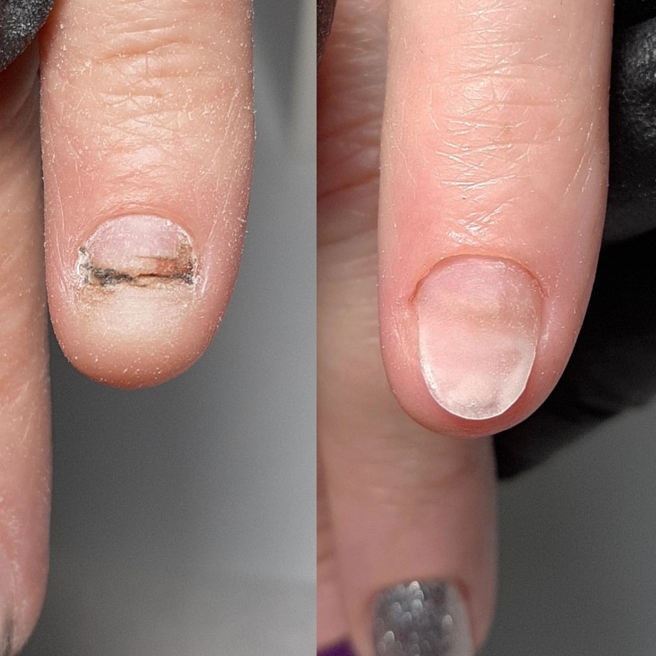 Ремонт 1 ногтя (маникюр)