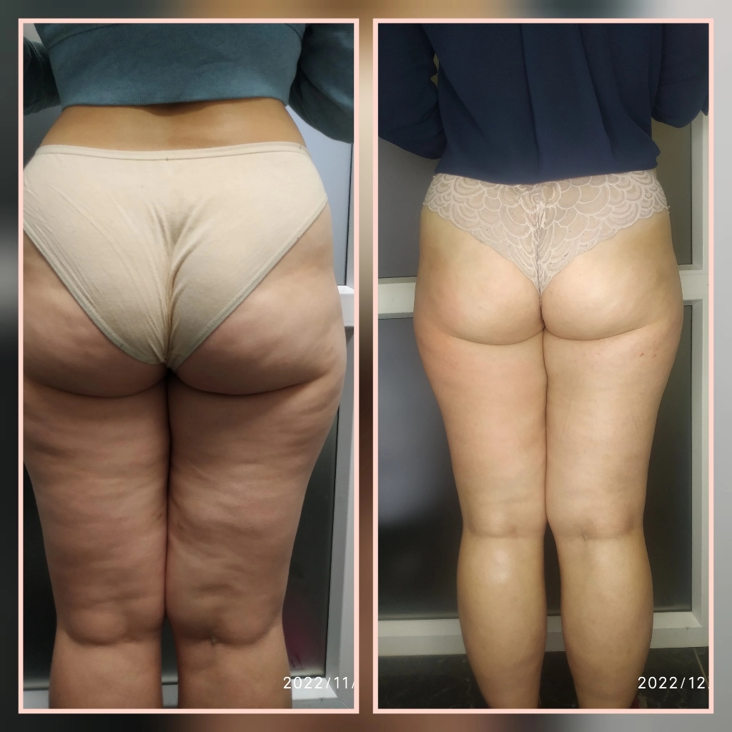 пробная процедура вакуумного массажа