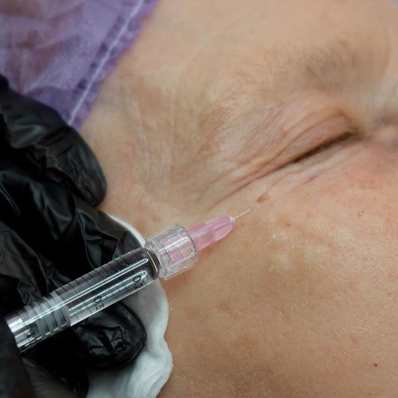 мезотерапия лица