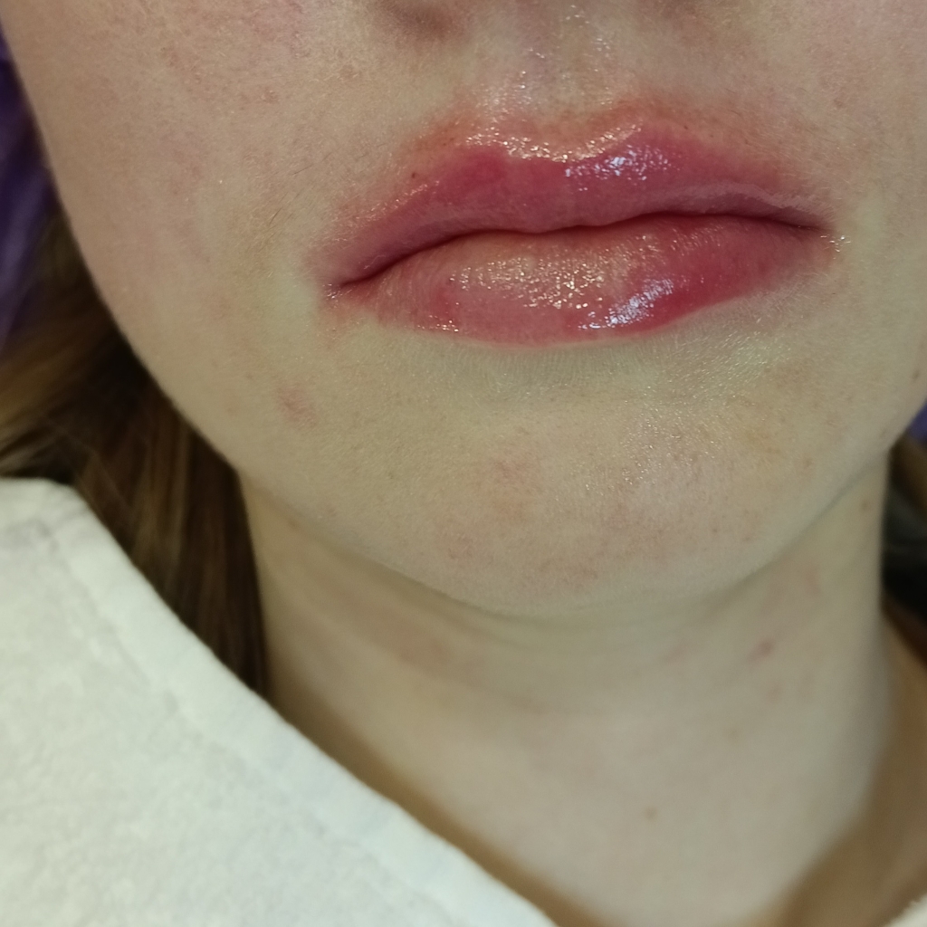 коррекция филлером