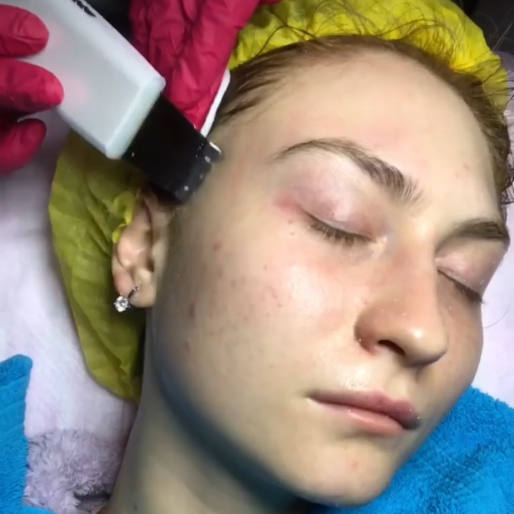 ультразвуковая чистка лица