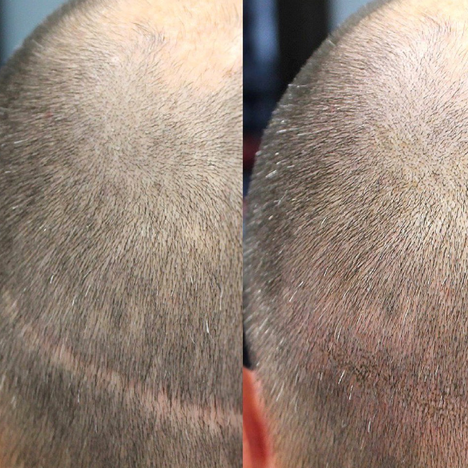 Придание густоты волос, камуфляж широкого пробора