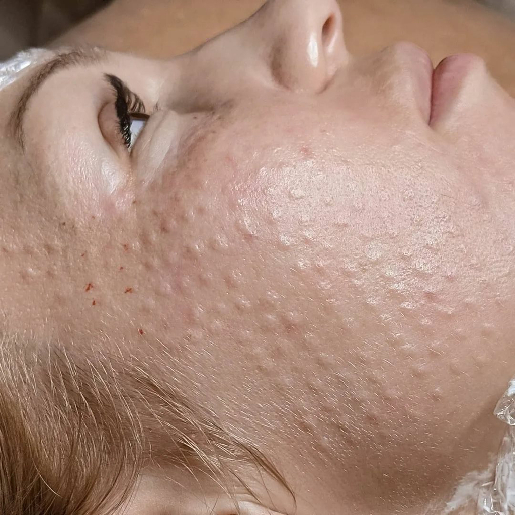 Мезотерапия лица,