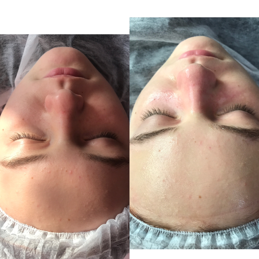 Чистка лица ( эстетика)