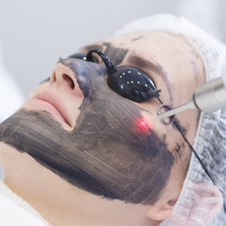 Карбоновый пиллинг лица