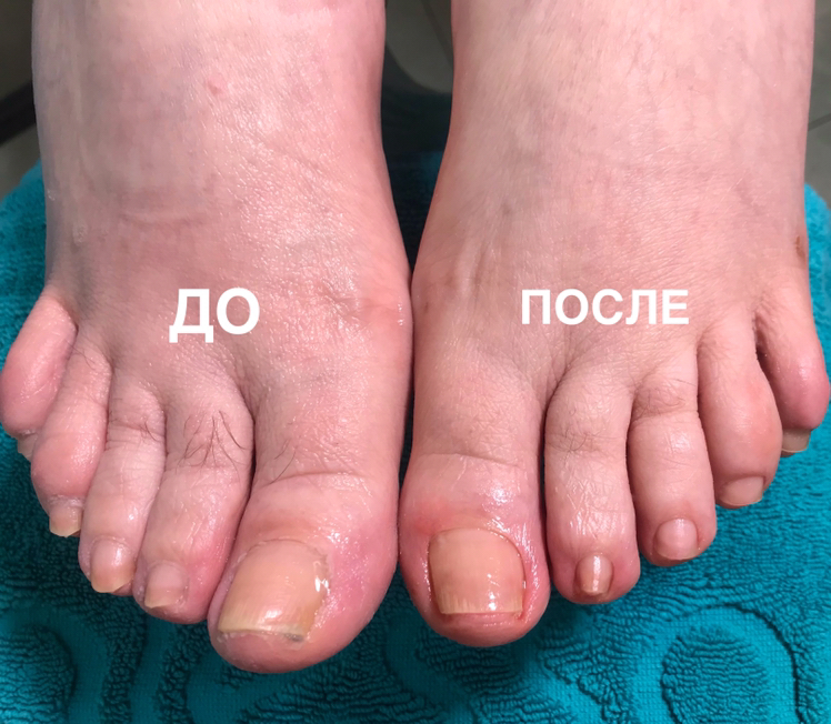 Обрезание  вросших  ногтей