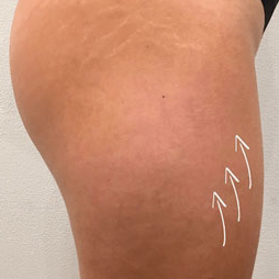 SMAS-лифтинг бедра