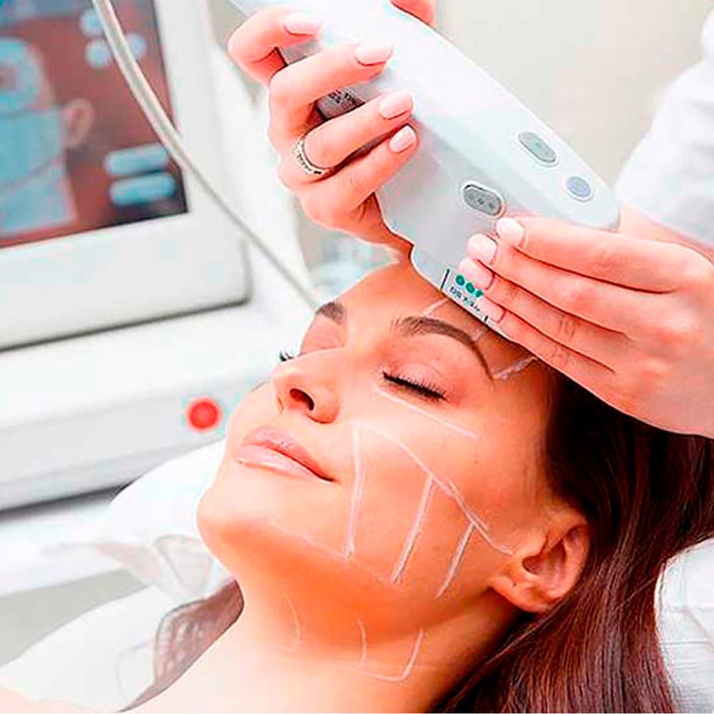 SMAS-лифтинг периорбитальная зона вокруг глаз